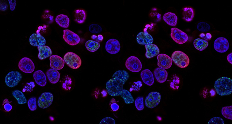 eye cancer 2 adult pediatric eyecare local eye doctor near you eye cancer 2 adult pediatric eyecare local eye doctor near you