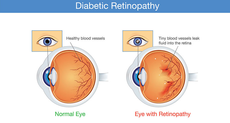 diabetic retinopathy adult pediatric eyecare local eye doctor near you diabetic retinopathy adult pediatric eyecare local eye doctor near you
