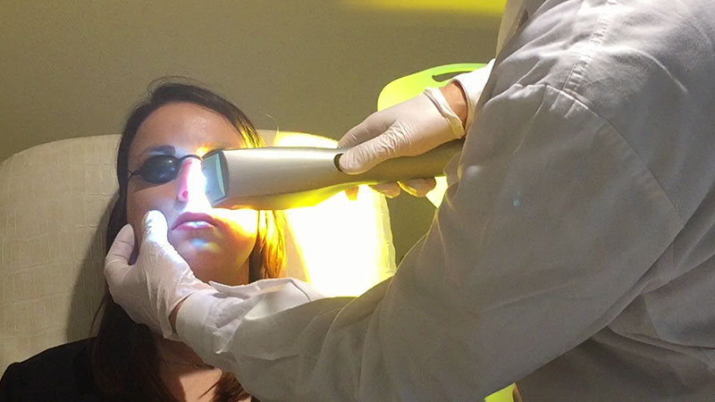 IPL dry eye treatment 2