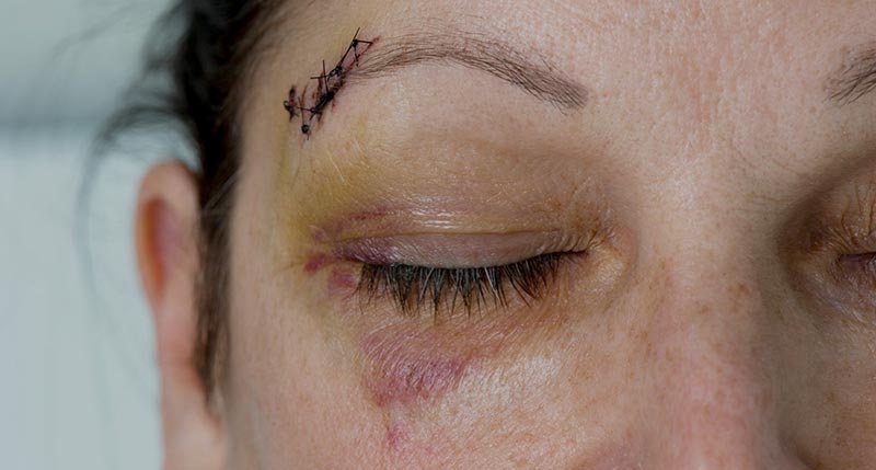 eye injury reduction adult pediatric eyecare local eye doctor near you.jpg eye injury reduction adult pediatric eyecare local eye doctor near you.jpg