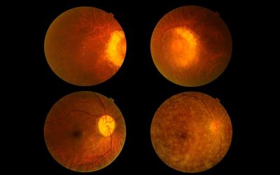 The Power of OCT Imaging for Protecting Eye Health